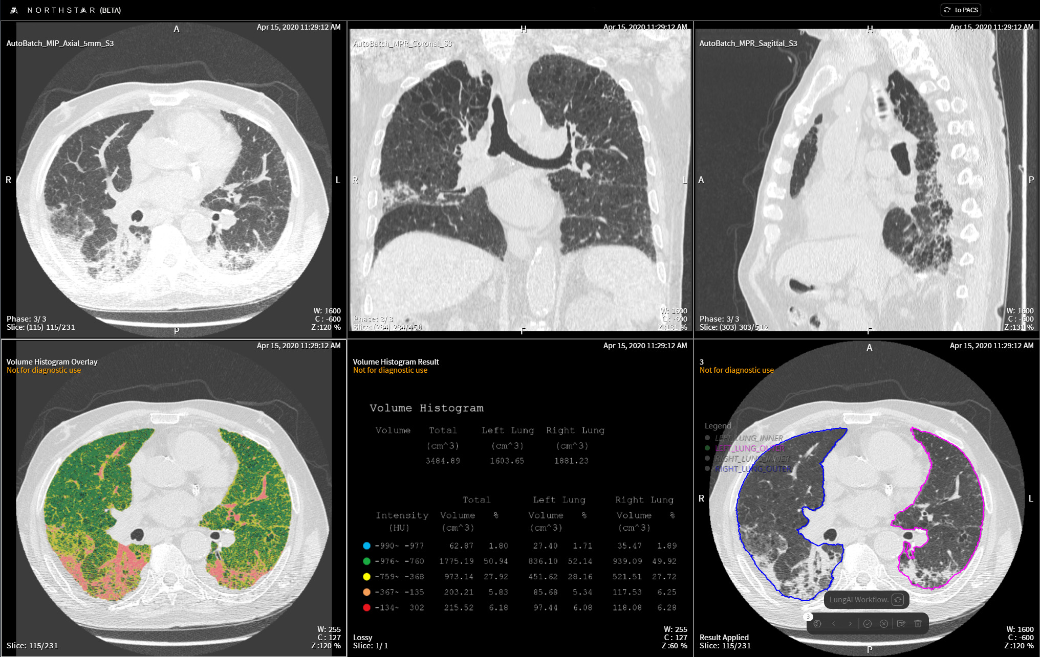 Lung Density Analysis II Workflow TeraRecon